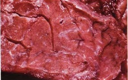 Фото: Муковисцидоз поджелудочной железы